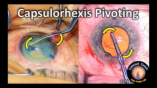 capsulorhexis pivoting during cataract surgery