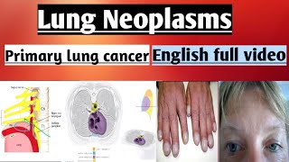 Lung Cancer | Lung Neoplasms