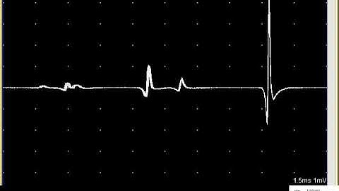 SFEMG - Split Muscle Fiber  (Erik Stalberg)