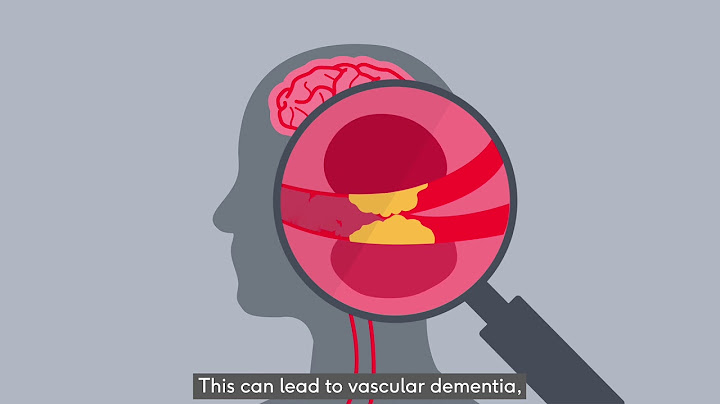 Bênh the symptoms of vascular dementia là gì năm 2024
