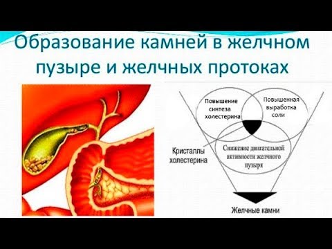 КАМНИ в ЖЕЛЧНОМ ПУЗЫРЕ и Печени - 2 главные ПРИЧИНЫ образования / Фролов Ю.А.