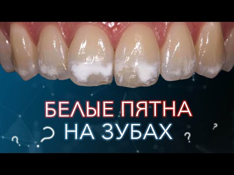 Белые пятна на зубах. Как понять это кариес или нет. Меловидные пятна.