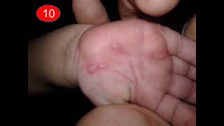 4Interactive_Dermatology_Clinic Images10 hand foot mouth disease 11  Atopic dermatitis 12  Freckles