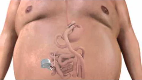 Lap-band vs Bypass Weight Loss Surgery