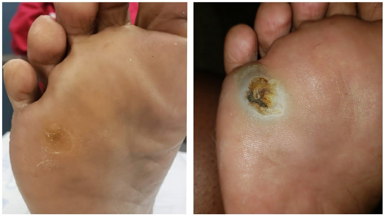 Unfortunately Its Back!! 😱 UPDATE on My Plantar Wart/ Callus/ Pitted