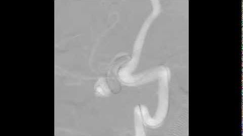 Intracranial aneurysm 1/3