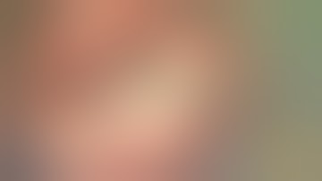 Epitympanic Malleus Ankylosis - Total Ossicular Chain Reconstruction & Stapes Silastic Banding