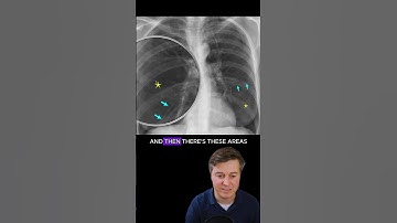 Emfyseem op de röntgenfoto van de borstkas
