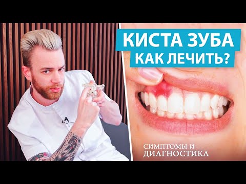 Киста зуба - как лечить. Симптомы и диагностика кисты зуба