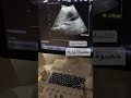 حصوة المراره بالسونار مع دكتورة شيماء عبيده