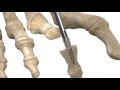 Stryker ToeTac | Implant for Hammertoe Fixation | Animation