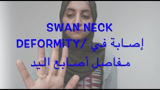 Swan Neck Deformity ،، إصابة مفصل أصابع اليد