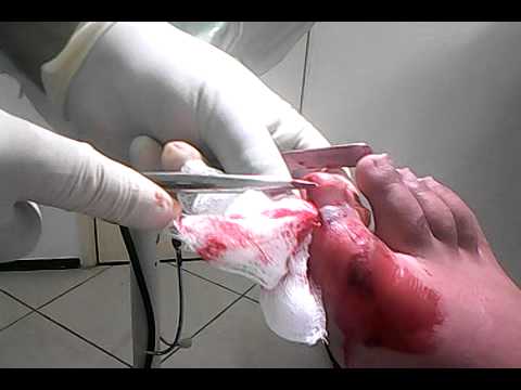 Minha cirurgia no dedo ! - YouTube