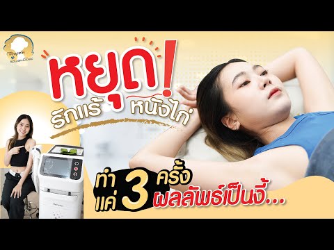 Diode Laser หยุด ❗ รักแร้ดำ หนังไก่ ทำ 3 ครั้งเห็นผลลัพธ์ทันที I รีวิวลูกสาวหมอ Sowon clinic ep.210