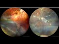 Stickler Syndrome_Retinal Detachment_Giant Retinal Tear