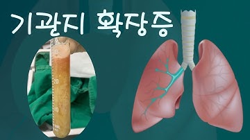 기관지 확장증