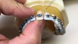 Provisório com Dente de Estoque em Ortodontia - Replacing missing teeth in Orthodontics