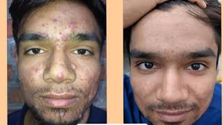 How To Remove Pimples Permanently | Acne Treatment | Healthy & Glowing Skin