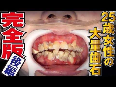 完全版後編 25歳女性の大量歯石remove Tartar 牙石去除 Complete Ed Latter Part歯石除去 Youtube 完全版後編 25歳女性の大量歯石remove Tartar 牙石去除 Complete Ed Latter Part歯石除去 Youtube