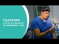 Удаление сосудистых звездочек по технологии F Care