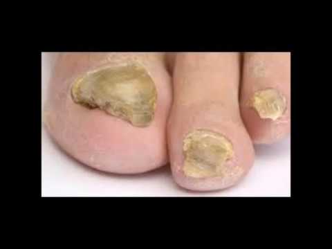 How To Get Rid Of Nail Fungus In A Day - Can You Cure Toenail Fungus? - YouTube
