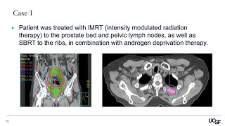 Recurrent Prostate Cancer Cases Panel