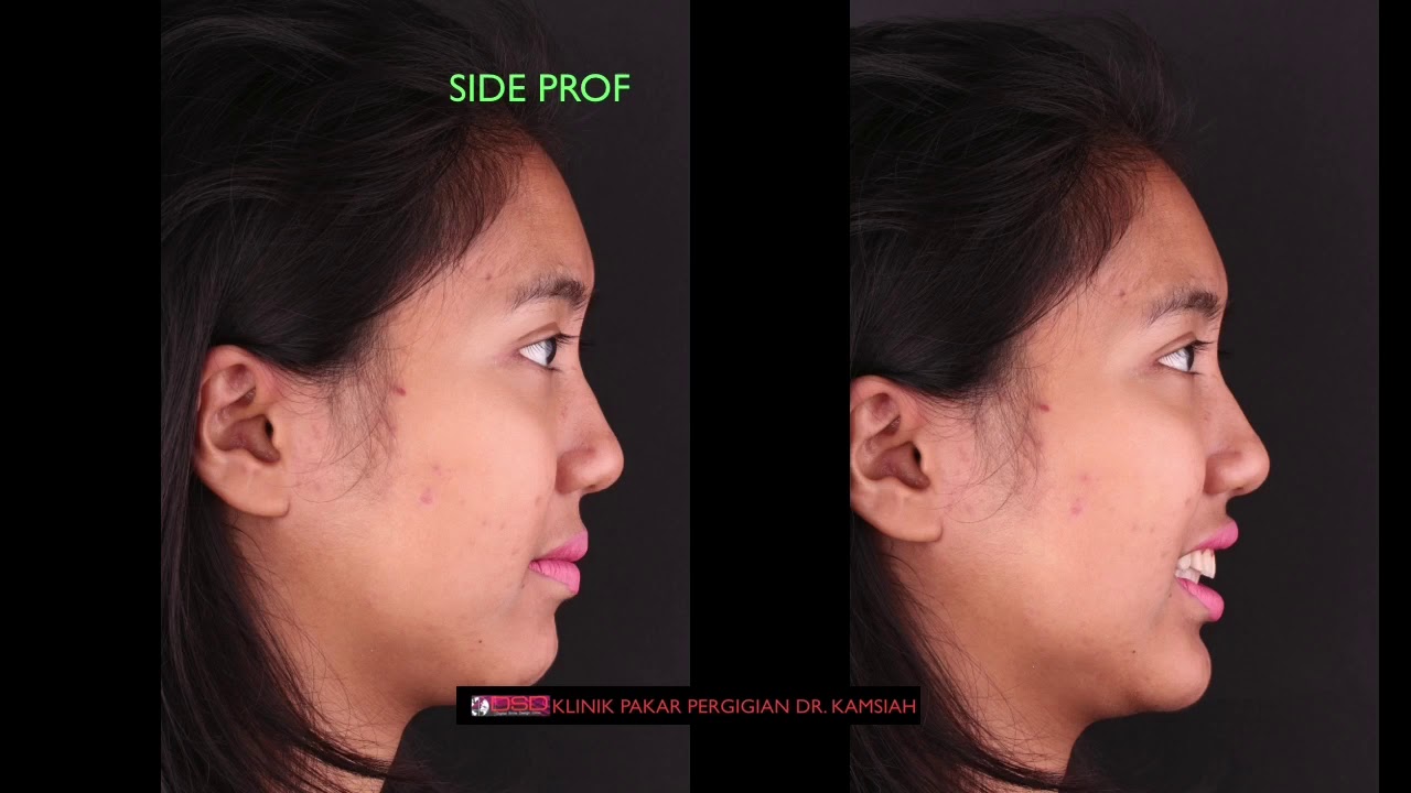 Anterior Open bite using Ortho Bone Screws