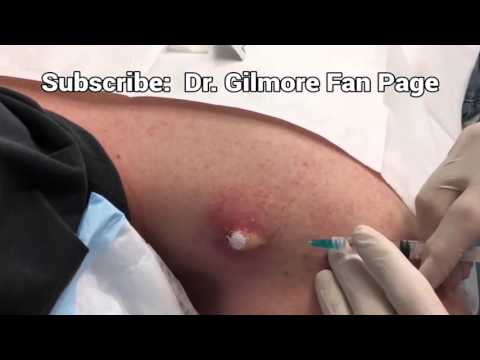 Abscesses, Dilated Pores & Sebaceous Cysts,  Dr. John Gilmore Fan Page