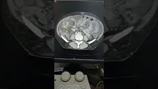 Abdomen and Pelvis with IV Contrast #shorts