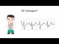 Recognizing ST segment changes on the stress ECG (EKG)