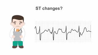 Recognizing ST segment changes on the stress ECG (EKG)