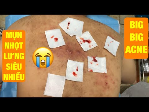 Nặn mụn nhọt phọt mủ mọc đầy lưng cho bạn sinh viên|Squeeze super big pimples on the back