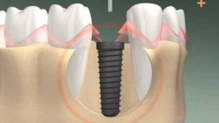 Zahnimplantation in 3D  Dental Implant 3D animation