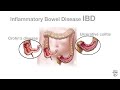 Mayo Clinic Minute: What is inflammatory bowel disease?