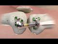 'Shock Absorber' for Knee Pain - UC Davis Among First to Place MISHA Implant for Osteoarthritis