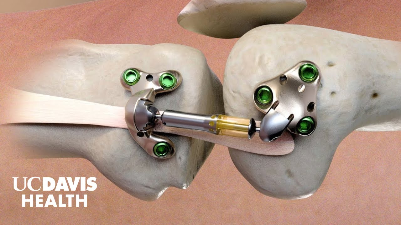 'Shock Absorber' for Knee Pain UC Davis Among First to Place MISHA