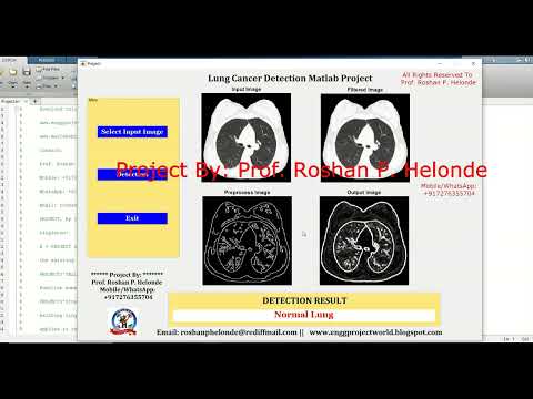 Lung Cancer Detection Using Image Processing | Source Code | Lung Cancer Classification Using Matlab