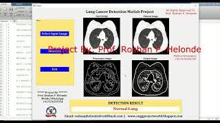 Lung Cancer Detection Using Image Processing | Source Code | Lung Cancer Classification Using Matlab Guide