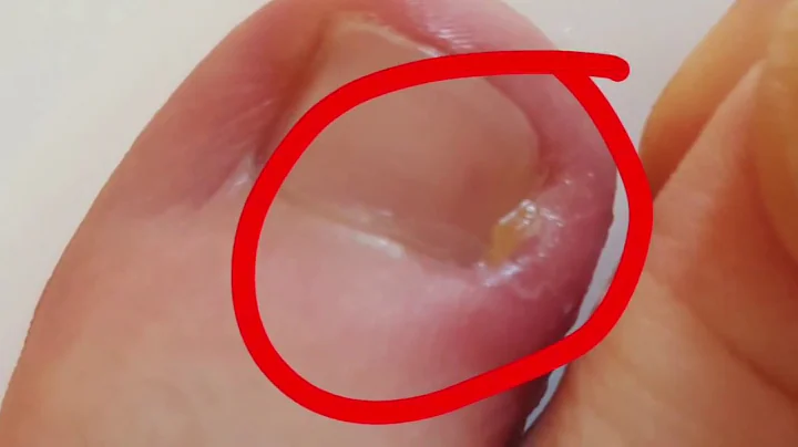 Ingrowing Toenail - Winograd Procedure