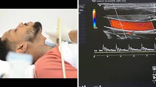 Carotid and Vertebral Arteries Doppler Ultrasound Protocols