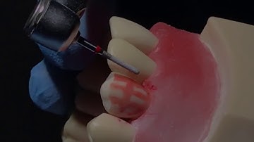 ADC Exam , PFM Crown Tricks