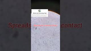 Trichomonas Lis Trichomoniasis Medicallabtechnologysajal6903