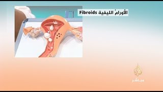 الورم الليفي في الرحم.. أعراضه وعلاجه
