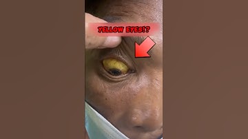 "Why Are My Eyes Turning Yellow? 😳 The Hidden Danger of Jaundice 🟡" #Jaundice #MedicalFacts #shorts