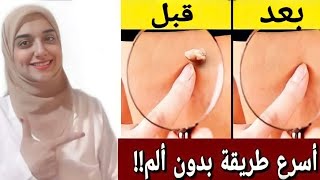 اسهل طريقه التخلص من الزوائد الجلديه و الثآليل في دقائق