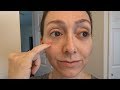 Cheek/Under Eye Injections (And Top Lip Too) | August 2019