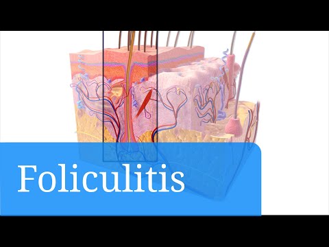Vídeo: Foliculitis Por Pityrosporum: Tratamiento Natural, Rostro Y Más