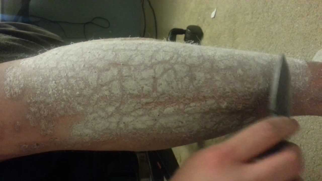 psoriasis removal)