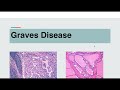 Graves Disease