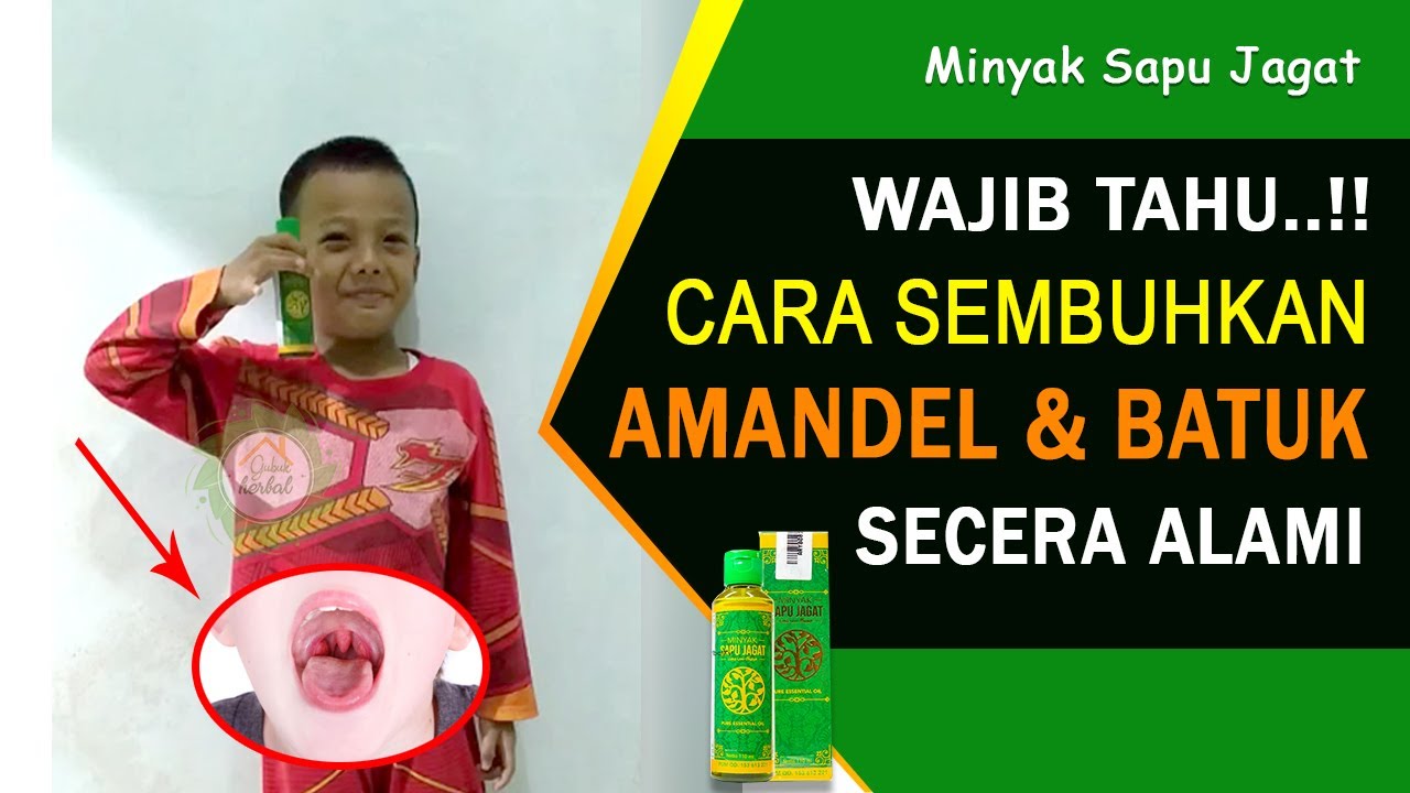 Obat Amandel sampai Kempes Total Tanpa Operasi - Sapu Jagat 